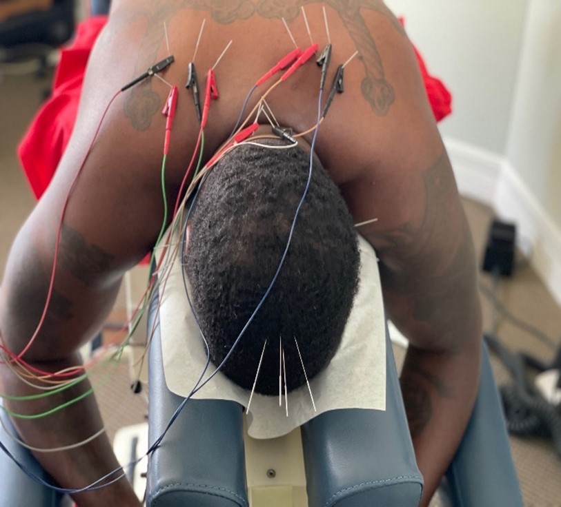 acupunture electro treatment at Restore Wellness Clinic in Melbourne FL