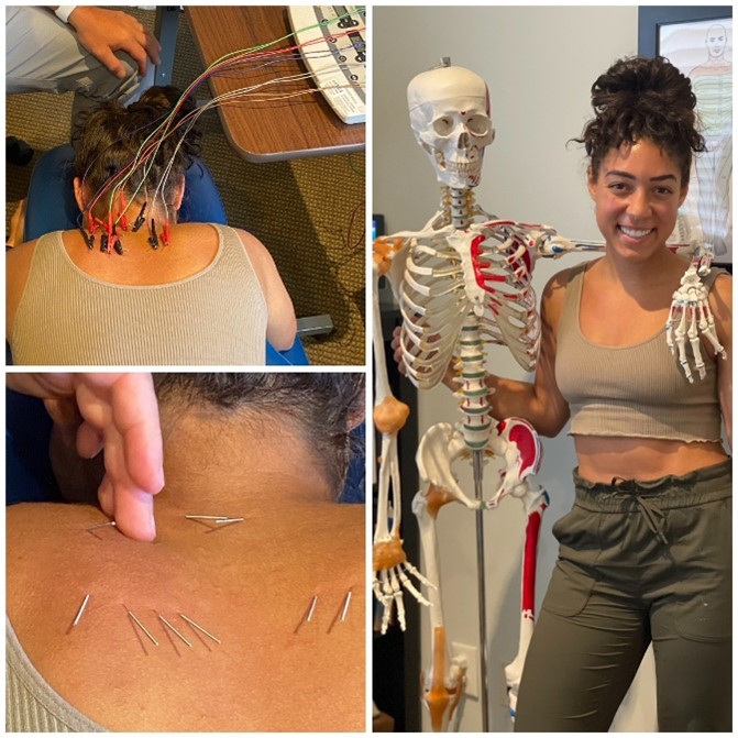acupunture treatment at Restore Wellness Clinic in Melbourne FL