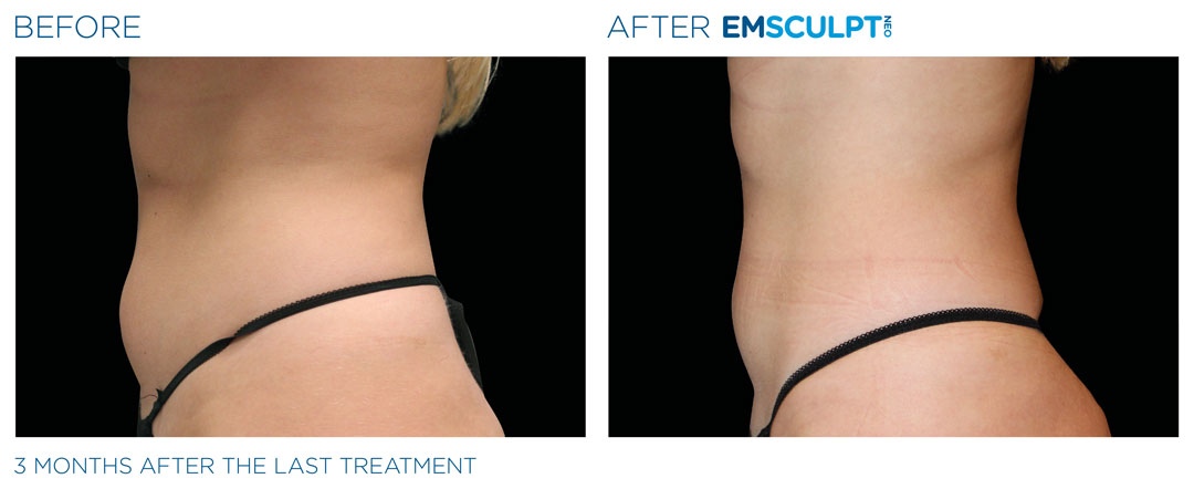 EMsculp-Neo-service-3-month-progress-in-Melbourne-by-Restore-Wellness-Center-Brevard-FL